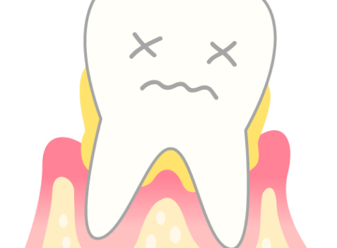 永久歯を失う主な原因はむし歯ではなく、歯周病です。